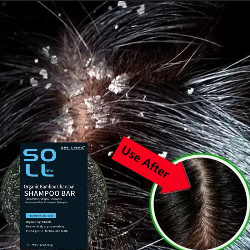 Hair Care Dandruff - Hızlı Kepek Önleyici Saç Bakım Sabunu