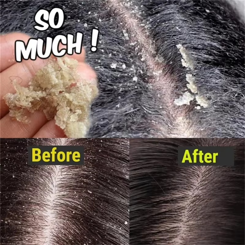 Hızlı Kepek Önleyici Saç Bakım - Hair Care Dandruff incelemesi ve fiyatı
